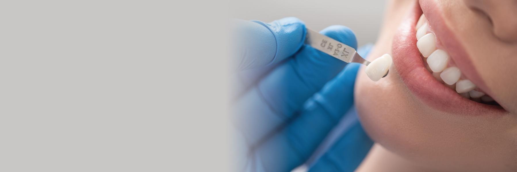 Porcelain Veneers | Dentist